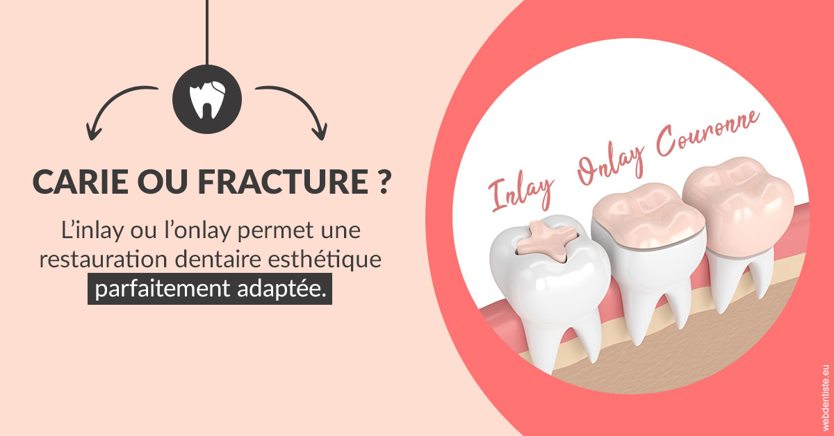 https://www.agoradent.fr/T2 2023 - Carie ou fracture 2