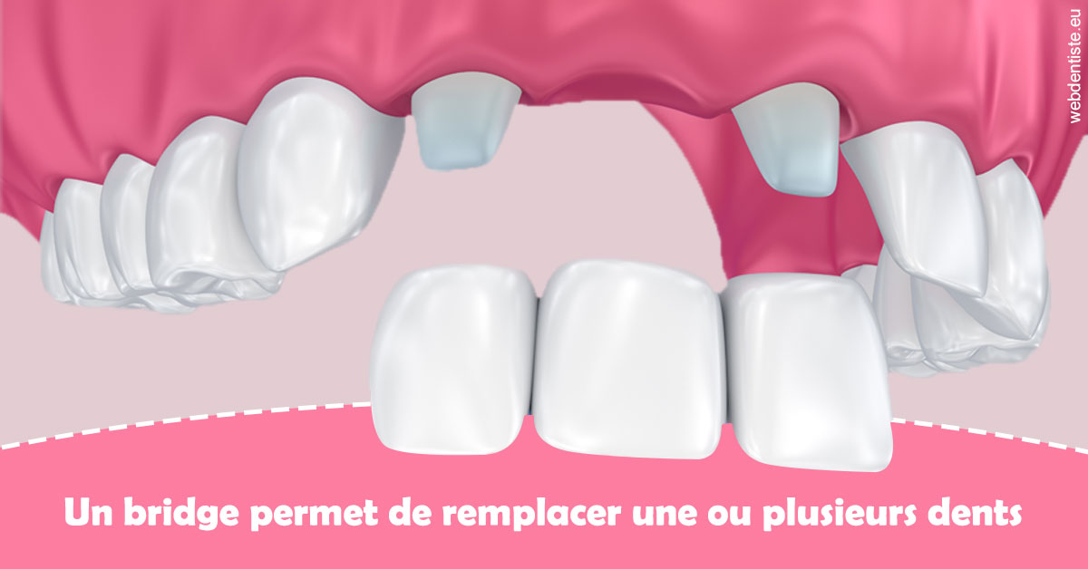 https://www.agoradent.fr/Bridge remplacer dents 2