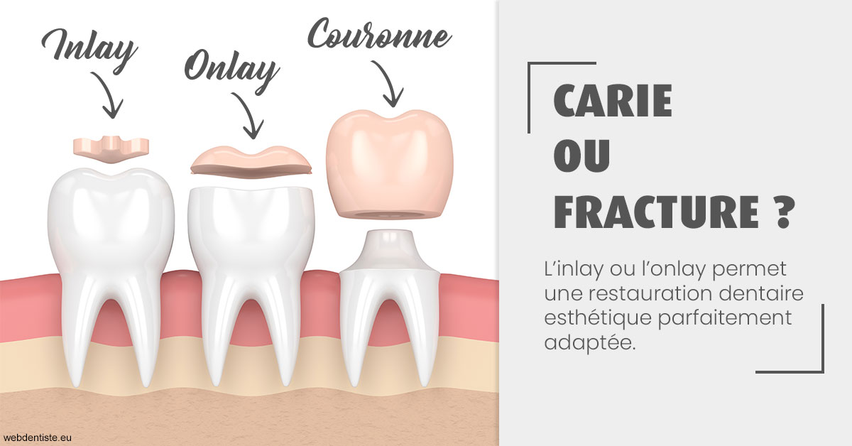 https://www.agoradent.fr/T2 2023 - Carie ou fracture 1