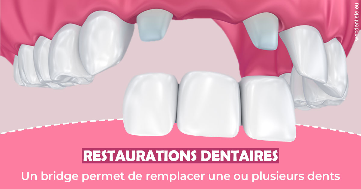 https://www.agoradent.fr/Bridge remplacer dents 2