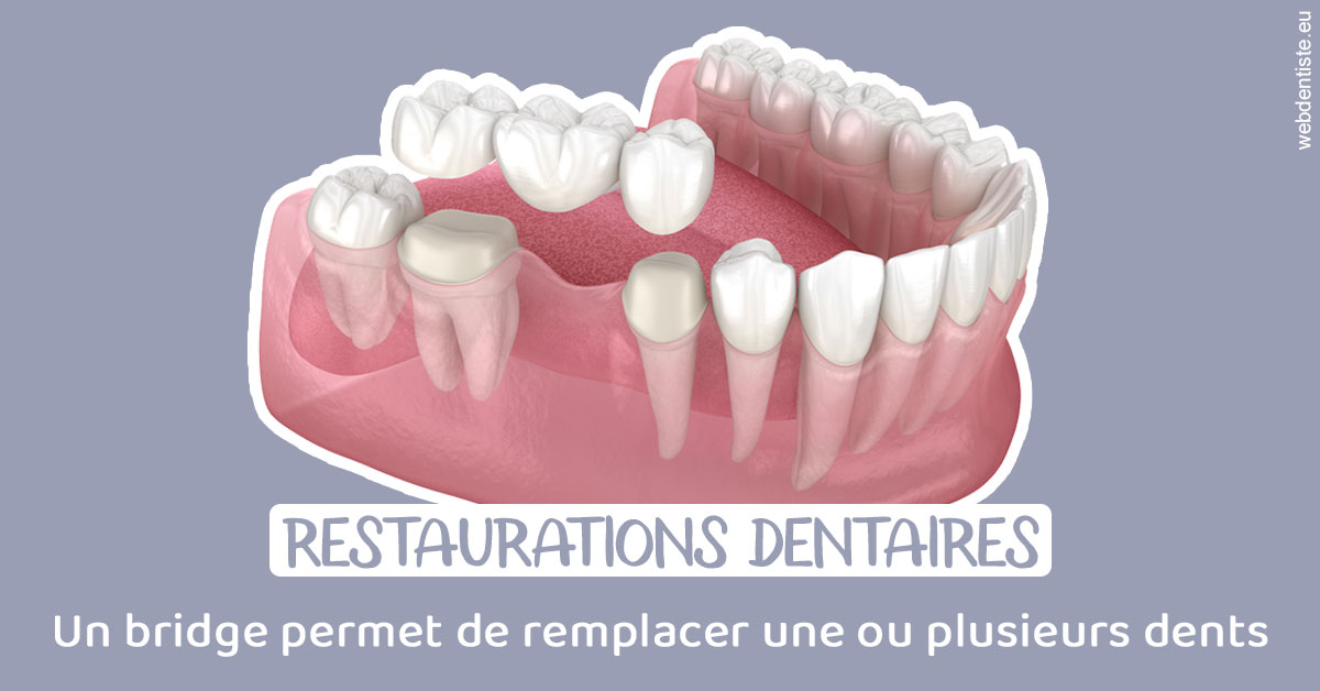 https://www.agoradent.fr/Bridge remplacer dents 1