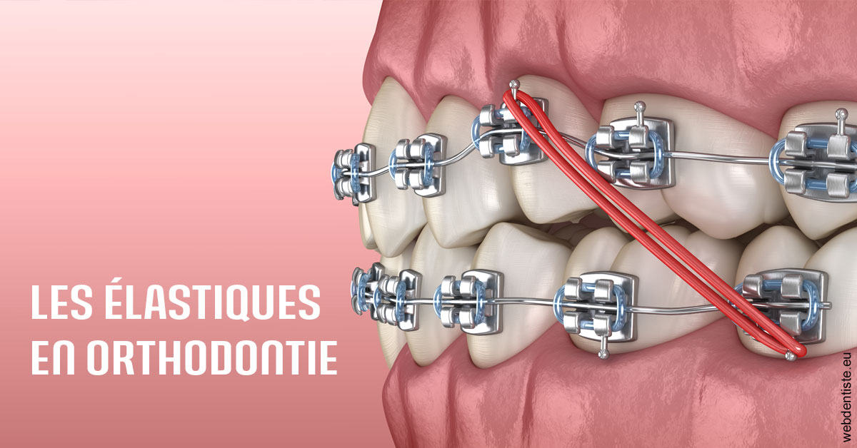 https://www.agoradent.fr/Elastiques orthodontie 2